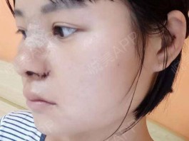 自体软骨隆鼻术多久消肿(自体软骨隆鼻术多久消肿啊)