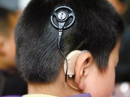 人工耳蜗多少钱一个
